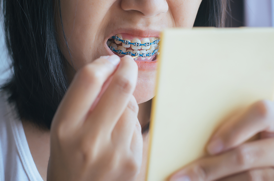 Understanding How Braces Correct Overcrowding and Create Space for Healthy Teeth